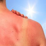 Sonnenbrand durch UV-Strahlung